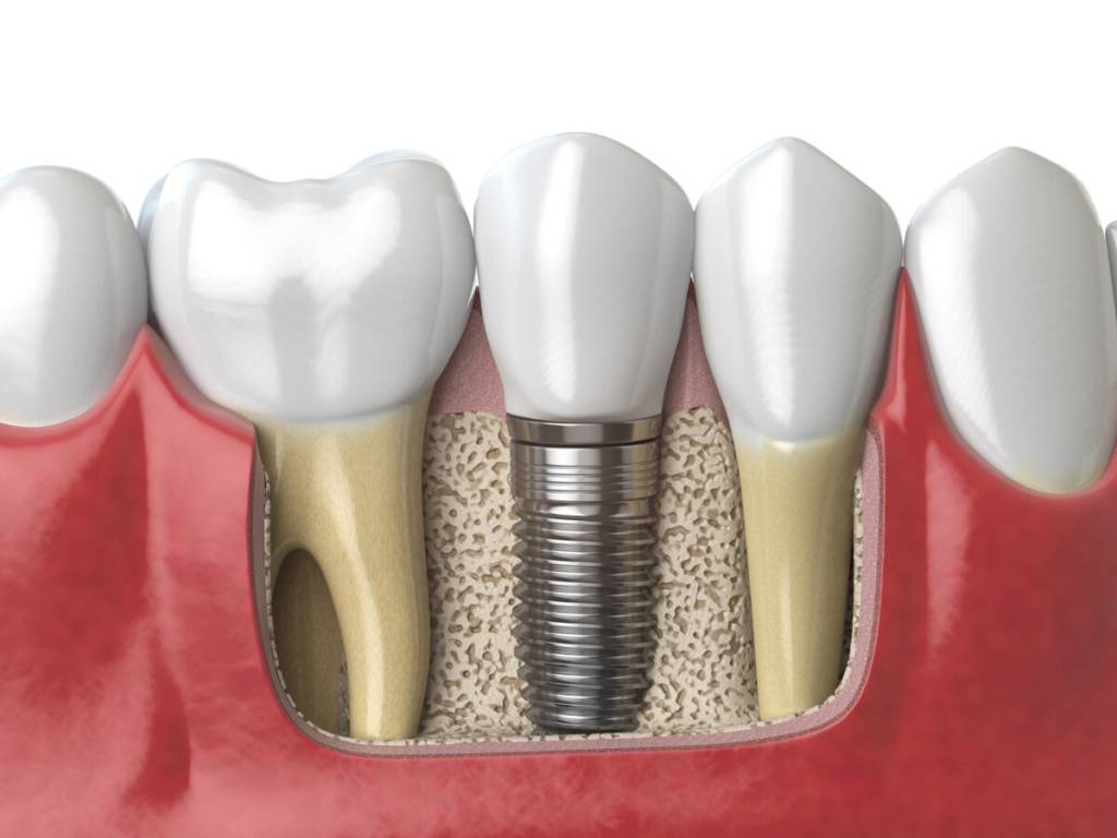 implant dentar pret